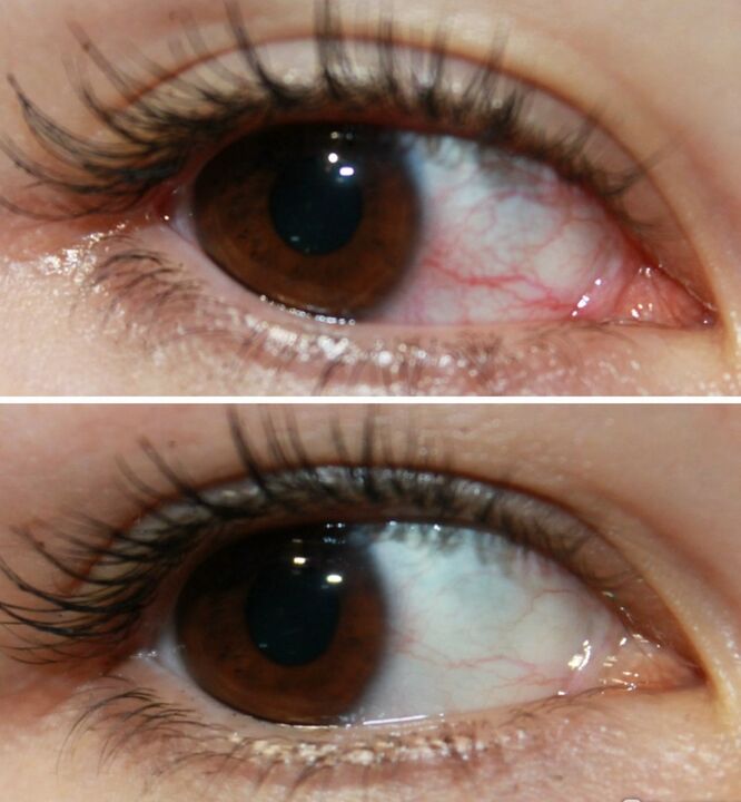 Ocuvit werkt zeer snel